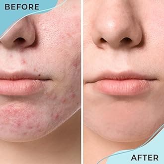 Cystic Hormonal & Severe Acne Spot Treatment for Face | Overnight Cystic Acne Treatment for Teens, Women, & Men with Sensitive Skin | Blind Pimple & Blemish Remover Cream | 120+ Treatments